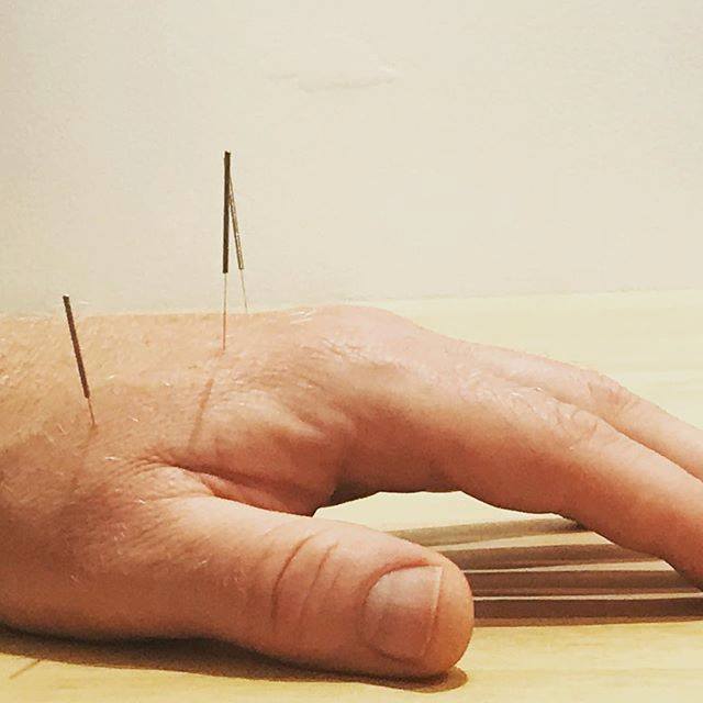 Acupuncture & Chinese Medicine, Brighton, Melbourne, Lower Back Pain