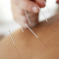 Acupuncture on someones back to relieve stress