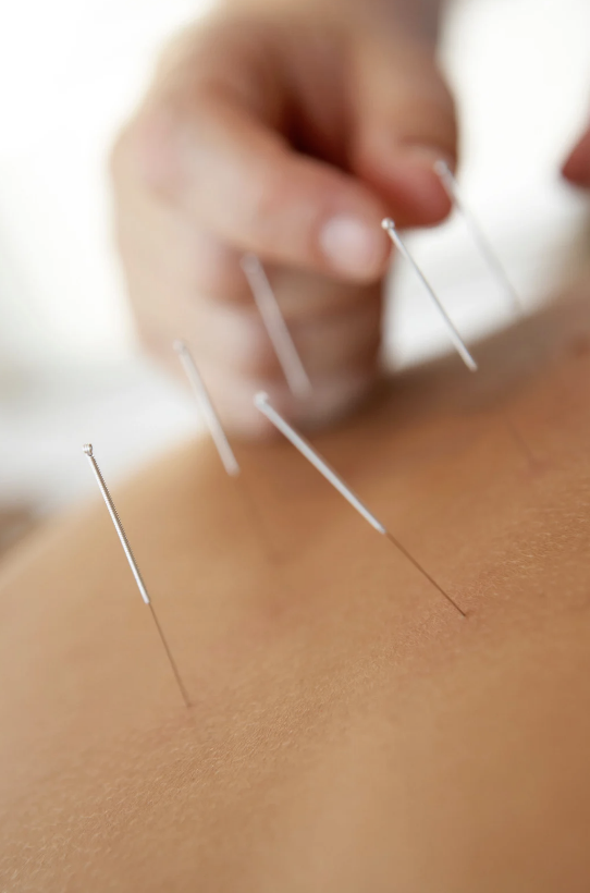 Acupuncture on someones back to relieve stress