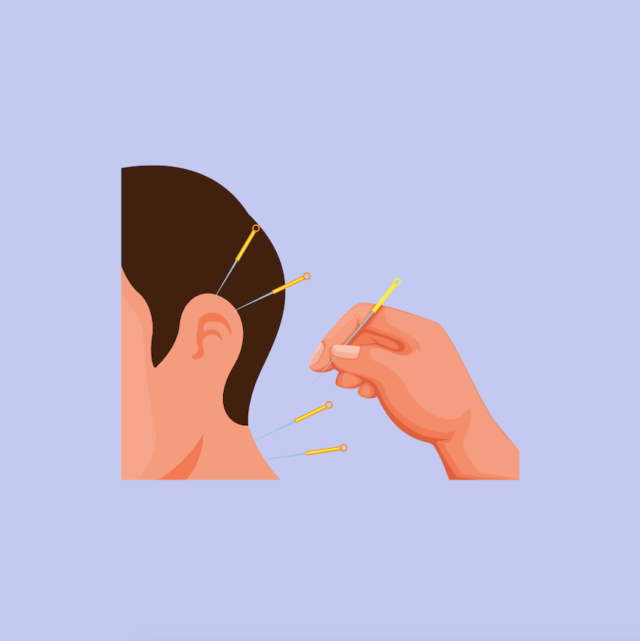 Dry needling vs Acupuncture